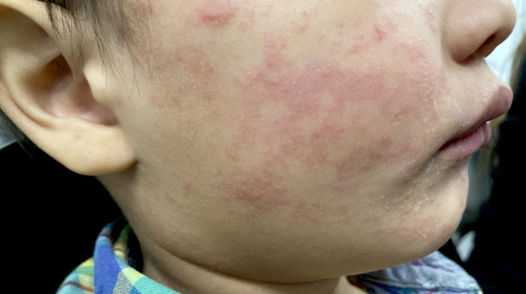 Health officials warn spring break travelers about rise in measles